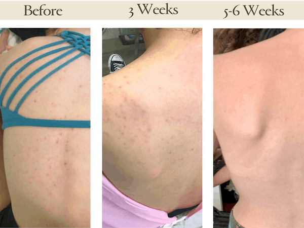 Before and After Skin Improvements using Miracle Sheets